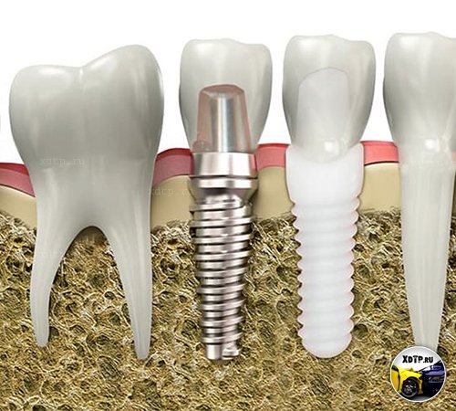 Импланты зубов. Возвращение улыбки и здоровья