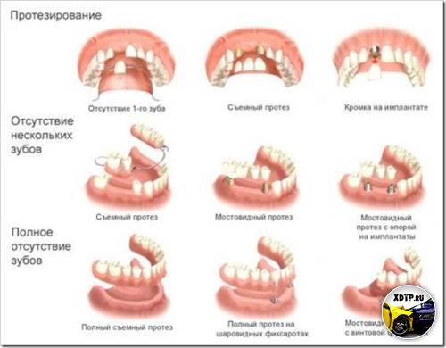 Имплантация зубов. Восстановление улыбки и здоровья